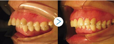 成人龅牙如何矫正
