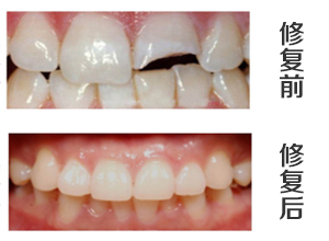 烤瓷牙的优点