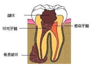 治疗牙髓炎费用需要多少