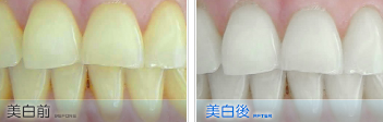 皓齿美白:重生你的美丽与自信