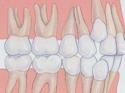 牙齿拥挤的原因是什么