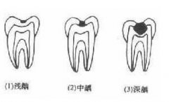 龋齿的预防