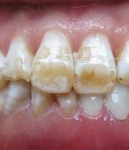 四环素牙出现时的症状