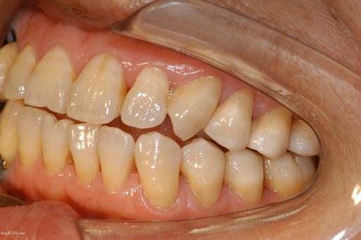 轻度四环素牙的牙齿症状