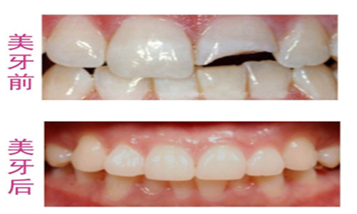 门牙断裂缺损的修复