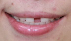 牙齿稀疏有哪些负面影响