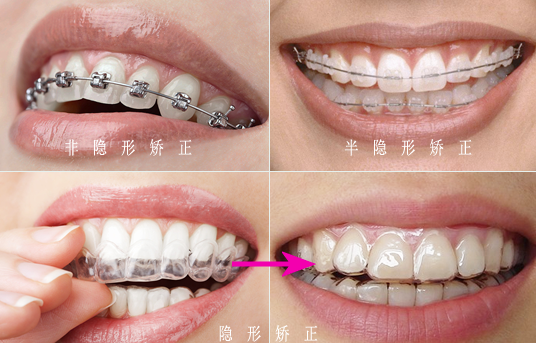 矫正牙齿稀疏的方法有哪些