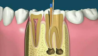 根管治疗有什么优点