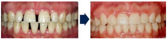 牙齿稀疏会造成哪些影响