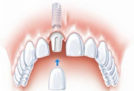牙齿空隙有什么办法可以矫正