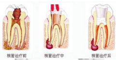 根管治疗后注意事项