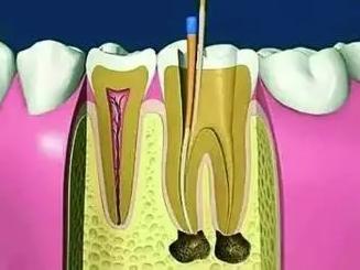 根管治疗后，牙齿酸痛为什么