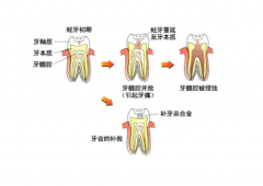 做完根管治疗为何会出现疼痛的情况