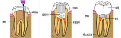做根管治疗要注意哪些常识