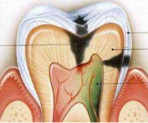 龋齿是怎样发生的