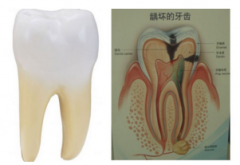 儿童龋齿的治疗方法怎么选择