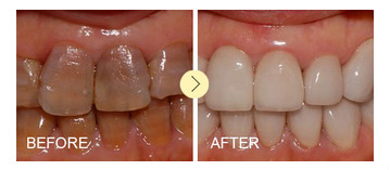 氟斑牙治疗效果对比图