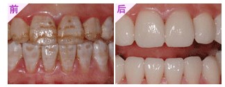 氟斑牙治疗前后的对比