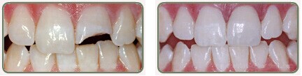 牙齿缺损修复前后对比